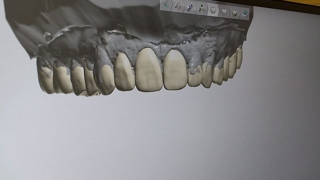 Digitales 3D-Modell eines Oberkiefers für die Planung von Zahnersatz