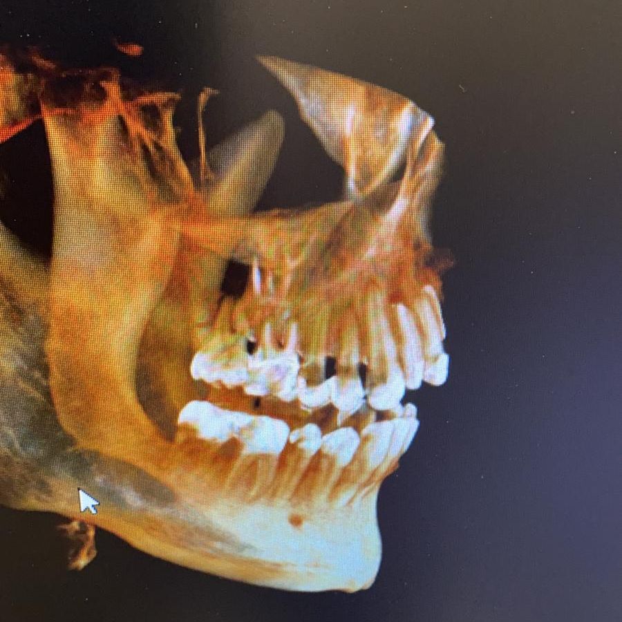 3D-Rekonstruktion von Ober- und Unterkiefer aus einer DVT-Aufnahme